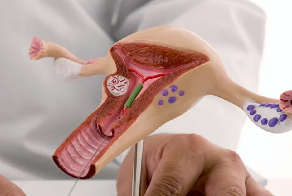 IUI